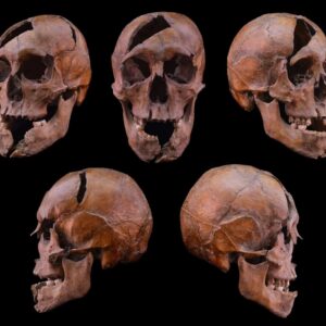 The skull of the investigated individual from the 13th century Dominican monastery on Margaret Island, Budapest